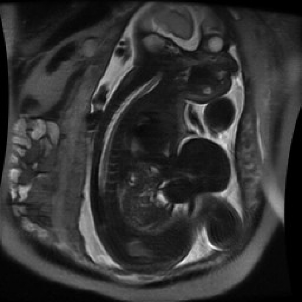 Omphal fetal MRI Image